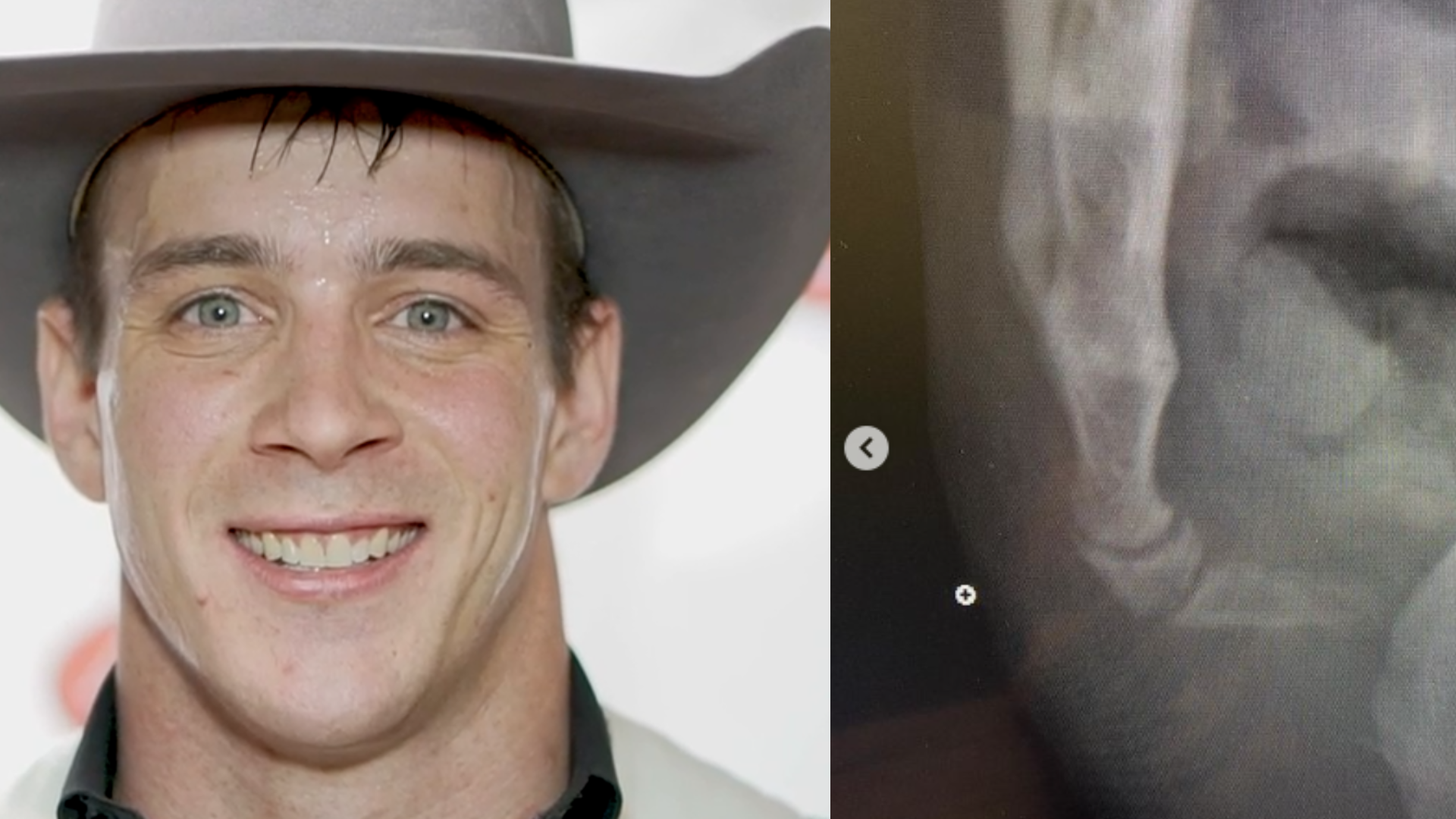 Tim O'Connell and His Broken Tailbone