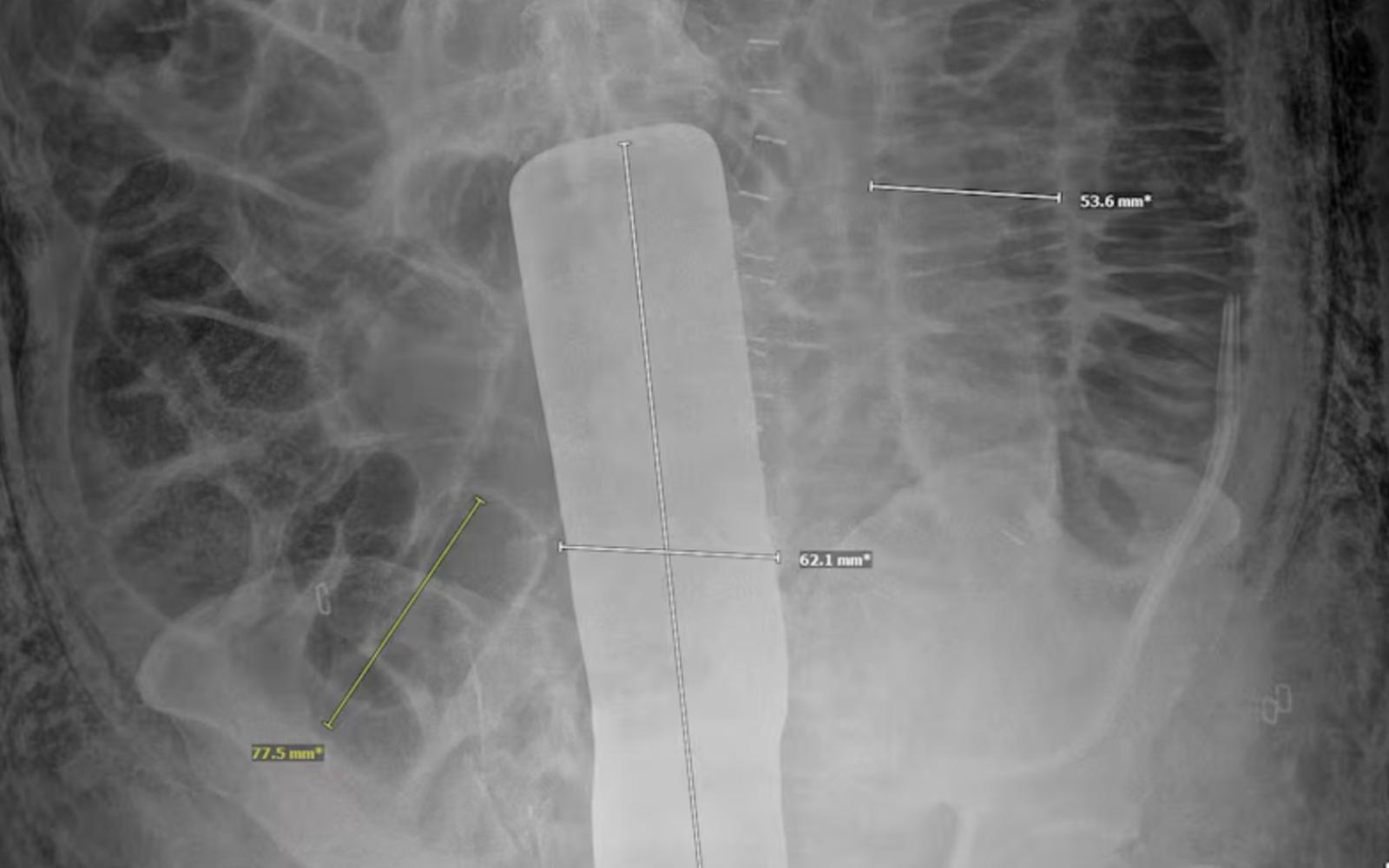 X-Ray of the Surgical Tool sealed inside Genaro Nava