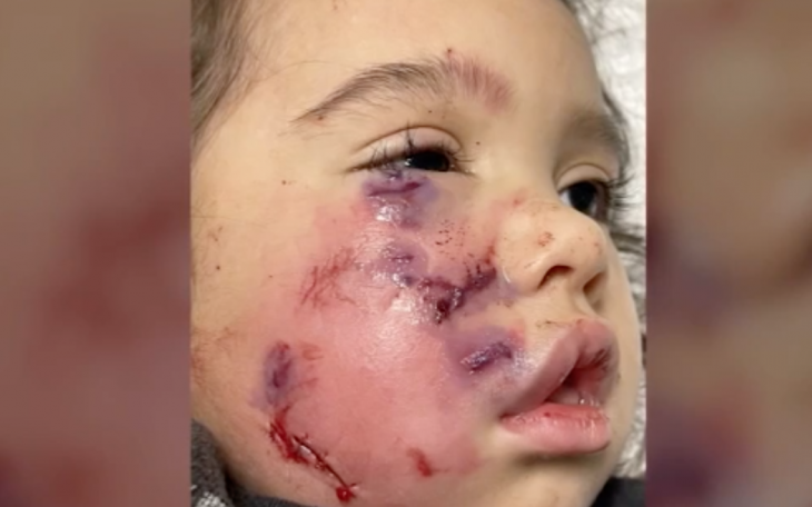 Child Bitten by a Pitbull in Harris County