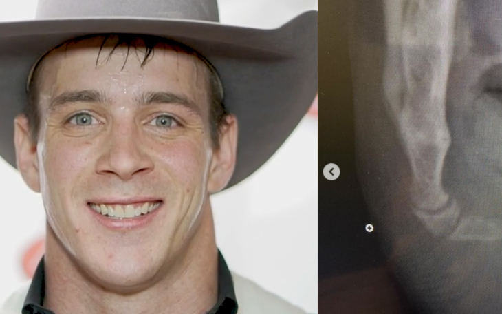 Tim O'Connell and His Broken Tailbone