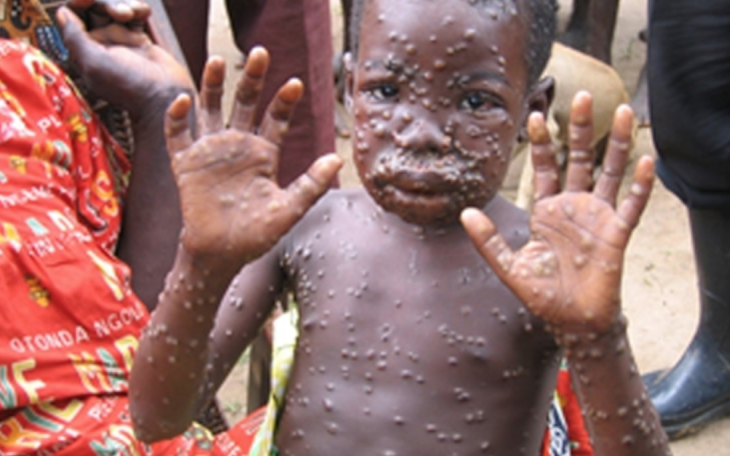 Child Infected with Monkeypox Virus (Contribute/nationalgeographic)