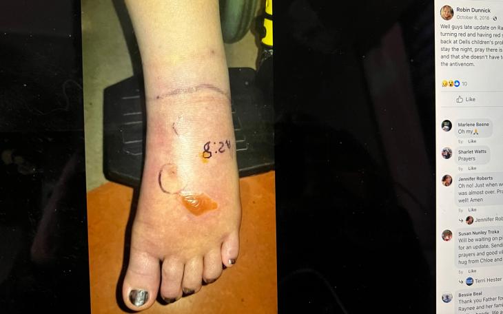 In this Oct 8, 2018 Facebook post, mom Robin Dunnick told her Facebook friends, "Well guys late update on Ray, her foot started turning red and having red spots so we are back at Dells children's probably gonna have to stay the night, pray there is no fang fragments and that she doesn't have to start all over with the antivenom."